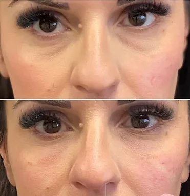 before and after treatment at renerative and joint clinic
