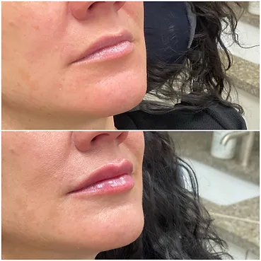 before and after treatment at renerative and joint clinic