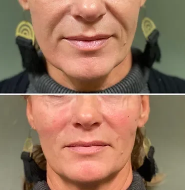 before and after treatment at renerative and joint clinic