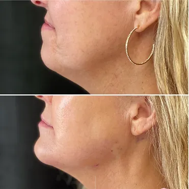 before and after treatment at renerative and joint clinic