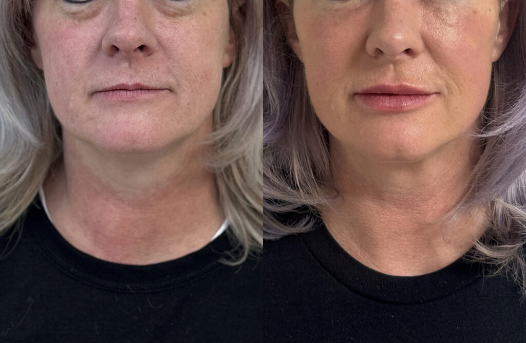 Lip, cheek, and undereye filler before and after photo by The Regenerative & Joint Clinic + Aesthetics in Pocatello, ID