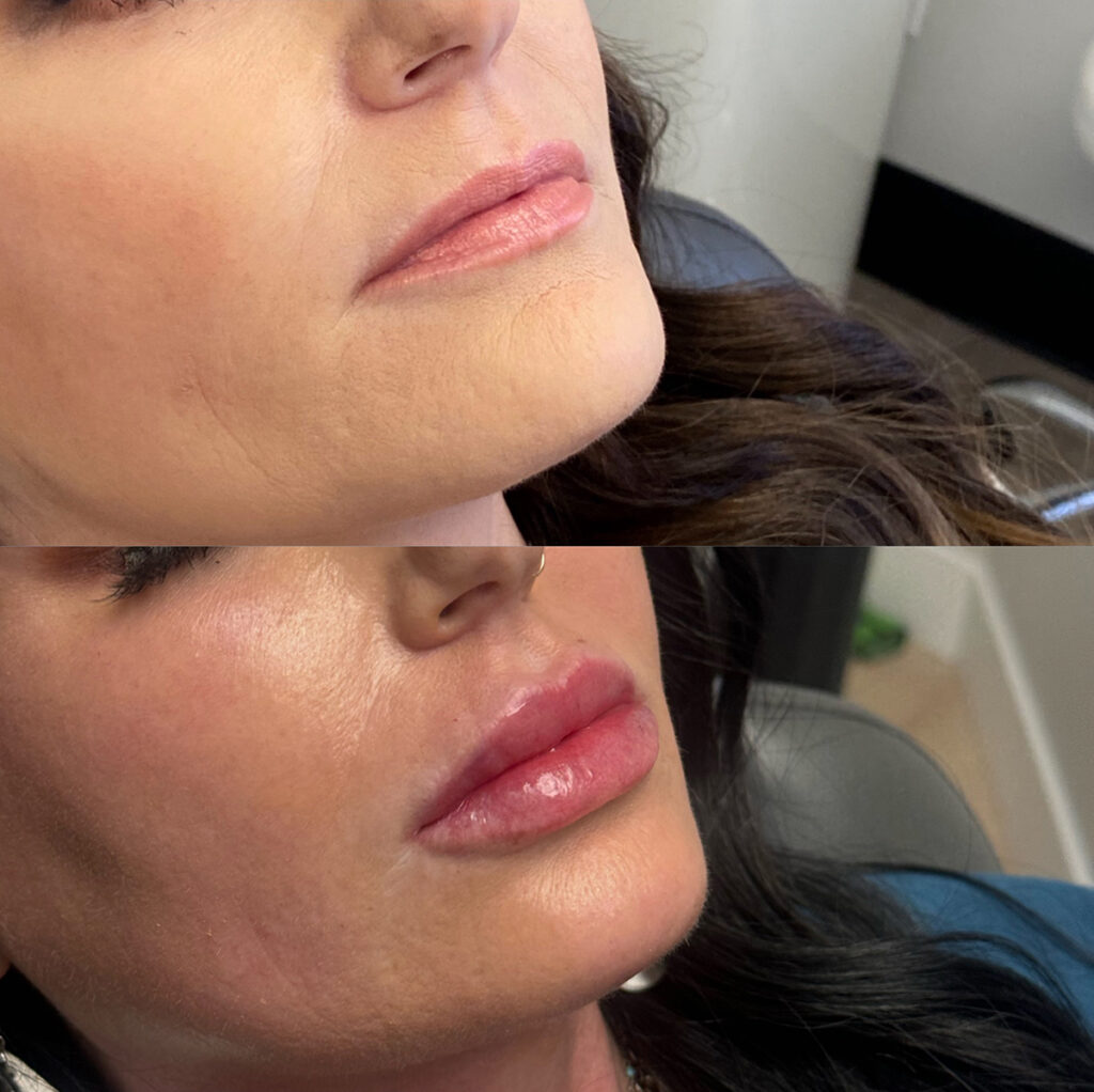 Lip filler before and after photo by The Regenerative & Joint Clinic + Aesthetics in Pocatello, ID