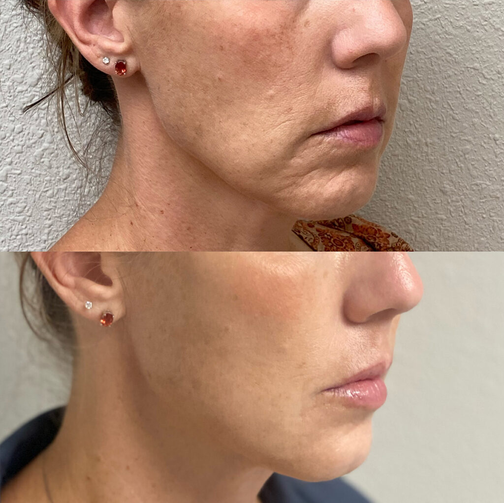 Thread lift and Fillers before and after photo by The Regenerative & Joint Clinic + Aesthetics in Pocatello, ID