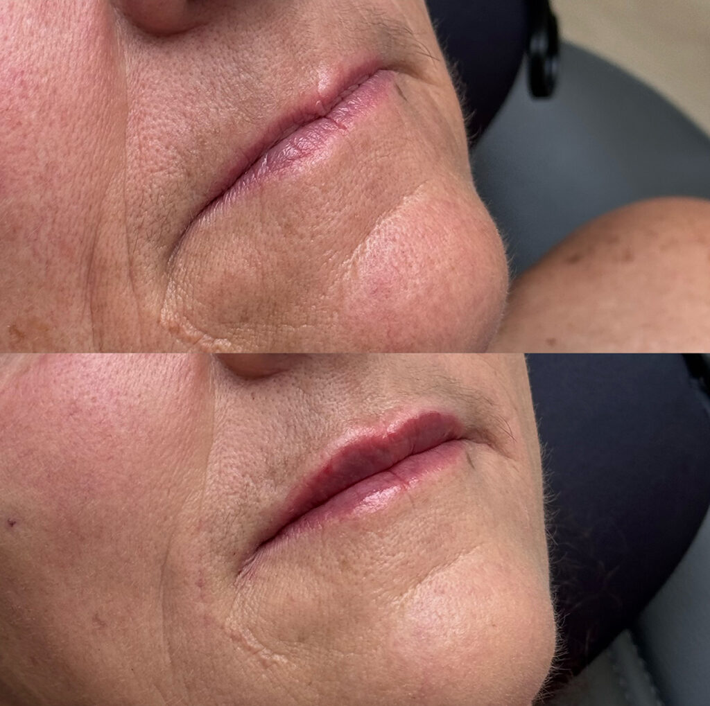Lip filler before and after photo by The Regenerative & Joint Clinic + Aesthetics in Pocatello, ID