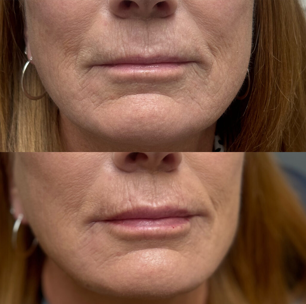 Lip filler before and after photo by The Regenerative & Joint Clinic + Aesthetics in Pocatello, ID