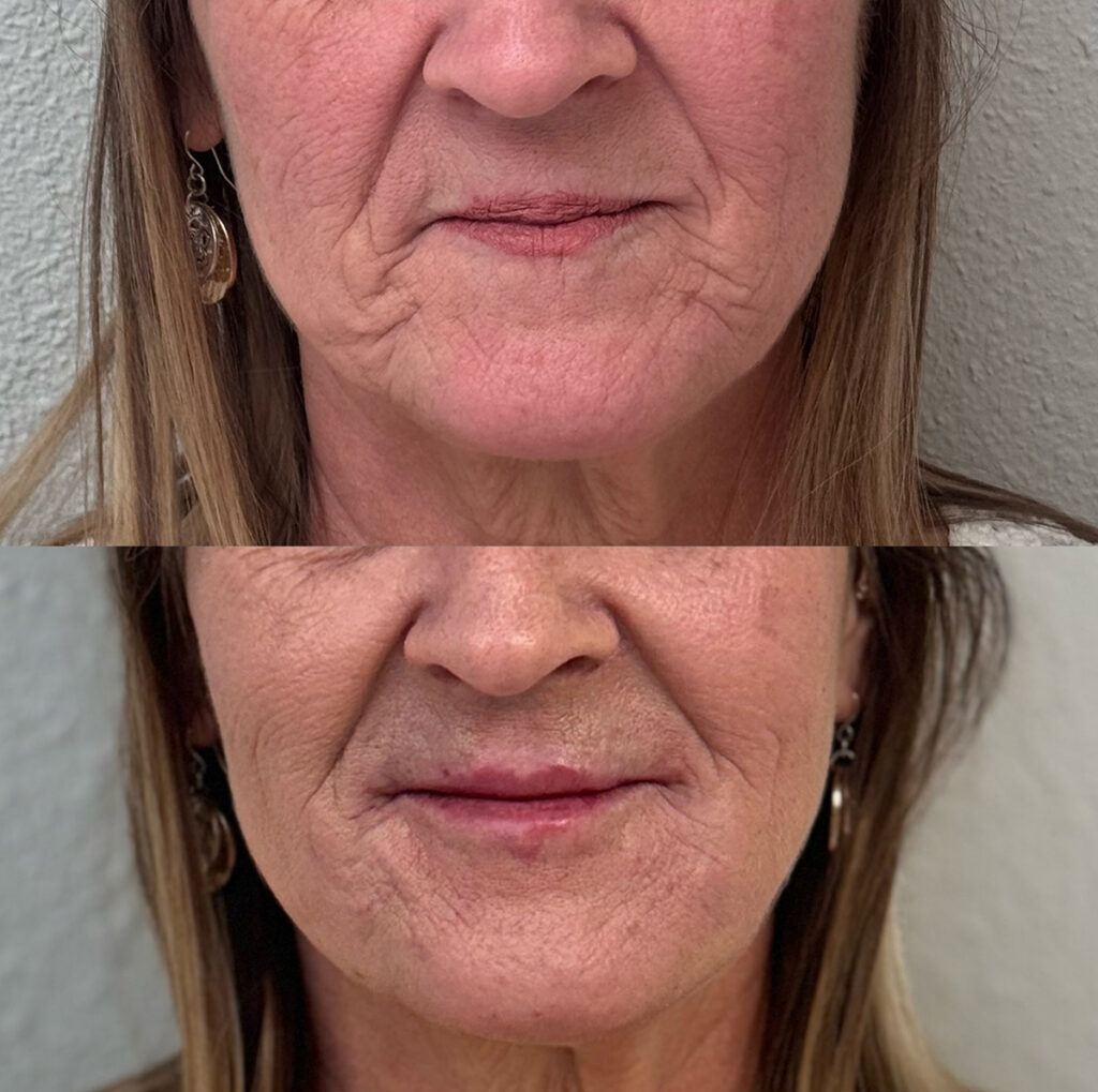 Lip filler before and after photo by The Regenerative & Joint Clinic + Aesthetics in Pocatello, ID
