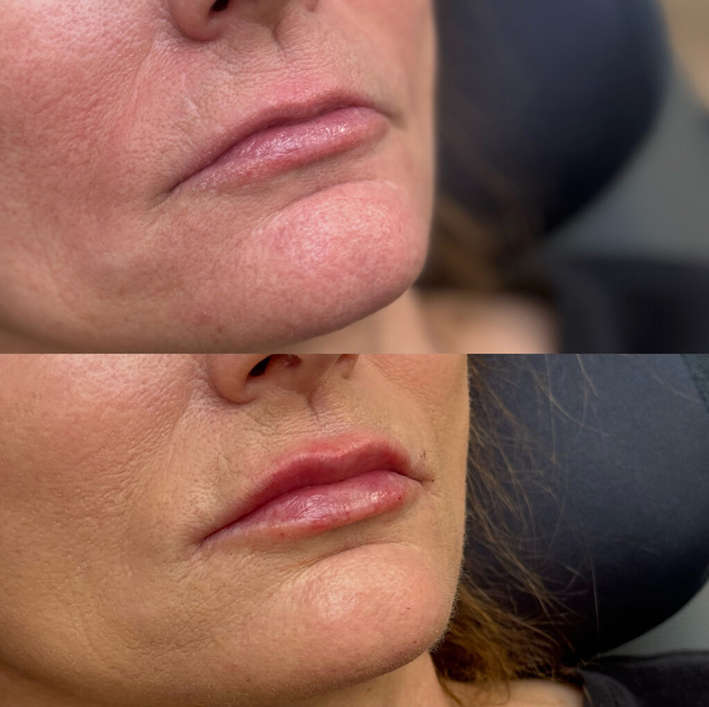 Lip filler before and after photo by The Regenerative & Joint Clinic + Aesthetics in Pocatello, ID