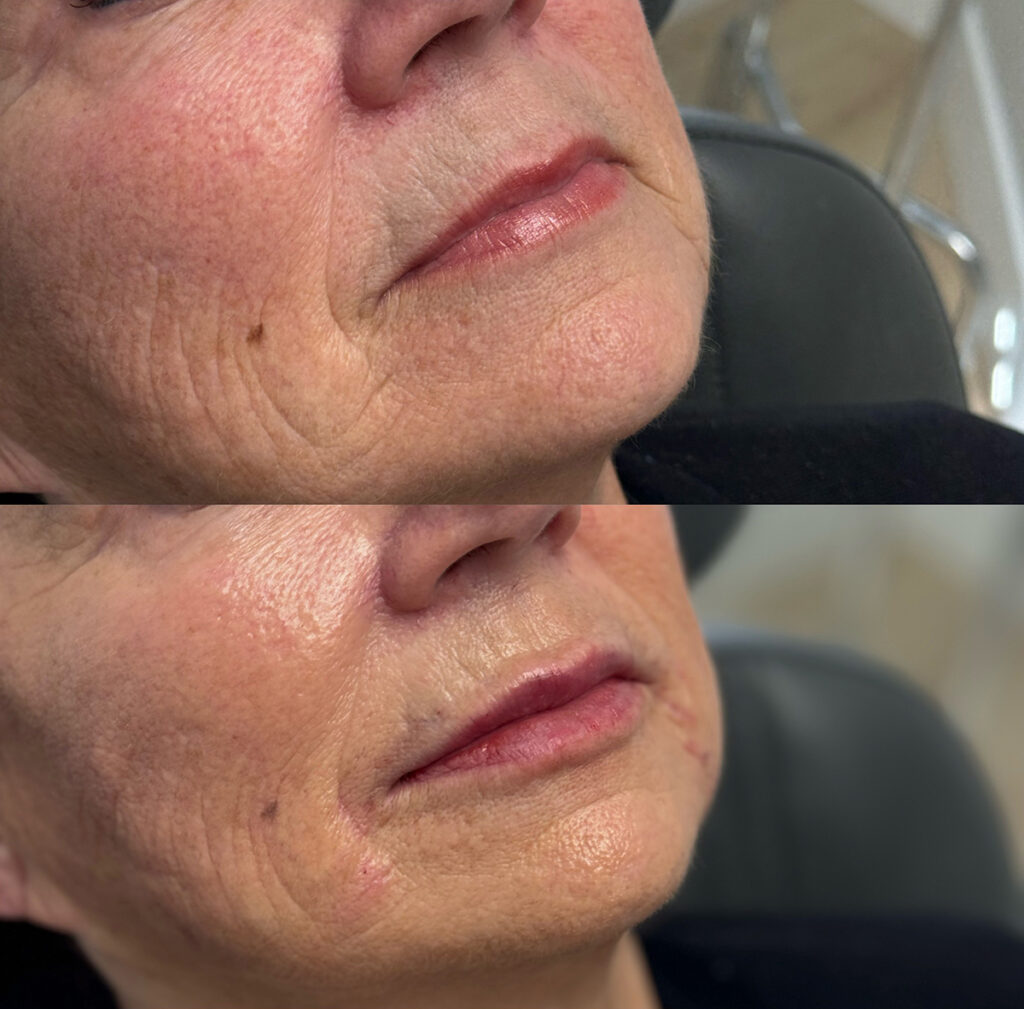 Lip filler before and after photo by The Regenerative & Joint Clinic + Aesthetics in Pocatello, ID