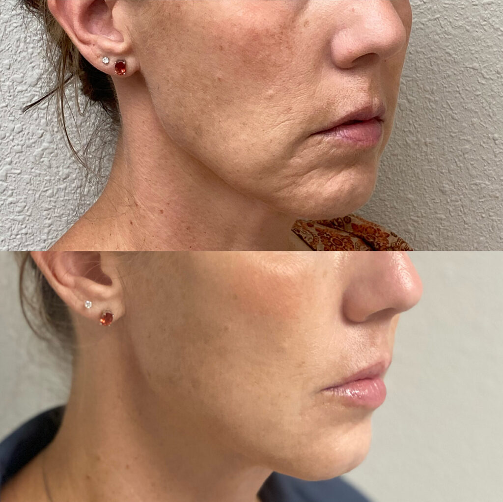 Thread lift & Filler before and after photo by The Regenerative & Joint Clinic + Aesthetics in Pocatello, ID