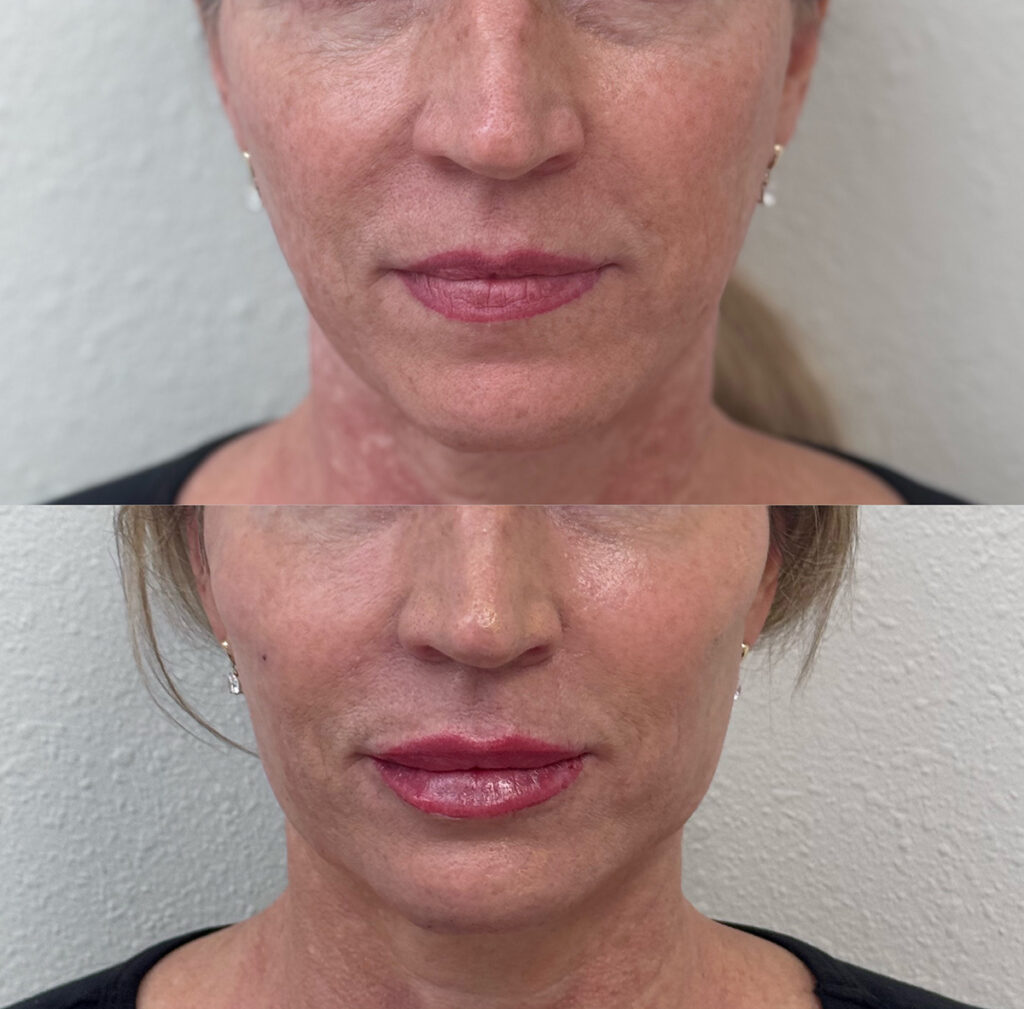 Lips and around mouth fillers before and after photo by The Regenerative & Joint Clinic + Aesthetics in Pocatello, ID