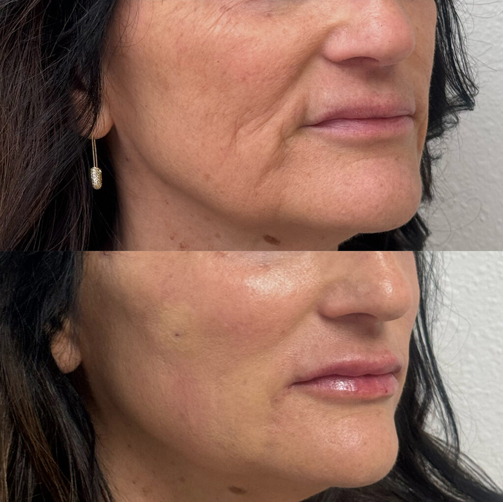 Thread lift and Fillers before and after photo by The Regenerative & Joint Clinic + Aesthetics in Pocatello, ID