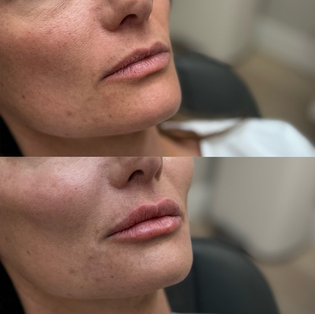 Filler cheeks lips marrionette before and after photo by The Regenerative & Joint Clinic + Aesthetics in Pocatello, ID
