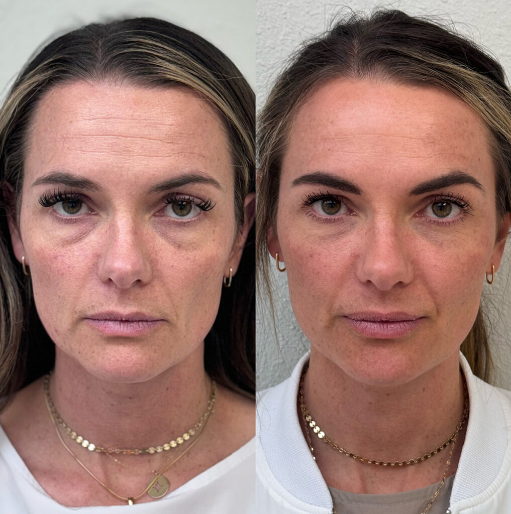 Cheek, tear trough, and lip fillers before and after photo by The Regenerative & Joint Clinic + Aesthetics in Pocatello, ID