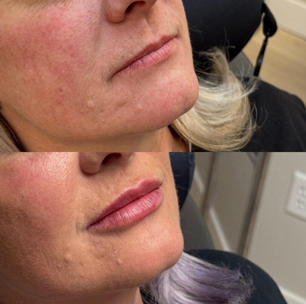 Lip and cheek filler before and after photo by The Regenerative & Joint Clinic + Aesthetics in Pocatello, ID