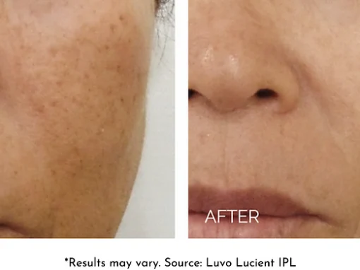 before and after IPL laser treatment renerative and joint clinic