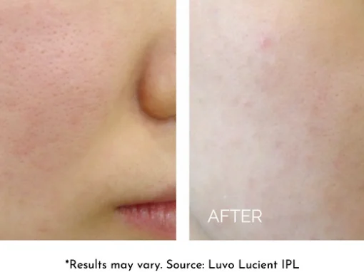 before and after IPL laser treatment renerative and joint clinic