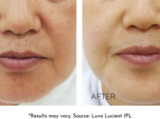 before and after IPL laser treatment renerative and joint clinic