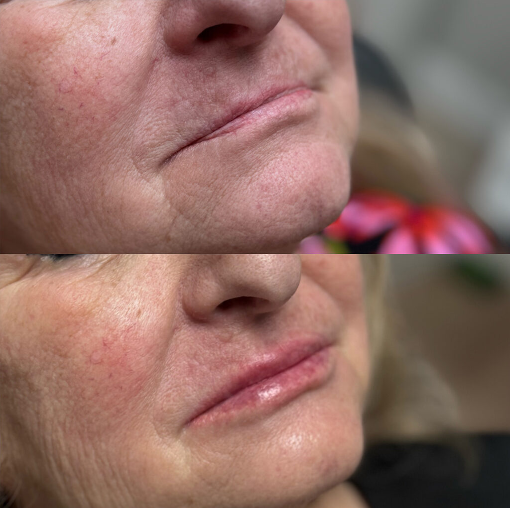 Lip filler before and after photo by The Regenerative & Joint Clinic + Aesthetics in Pocatello, ID