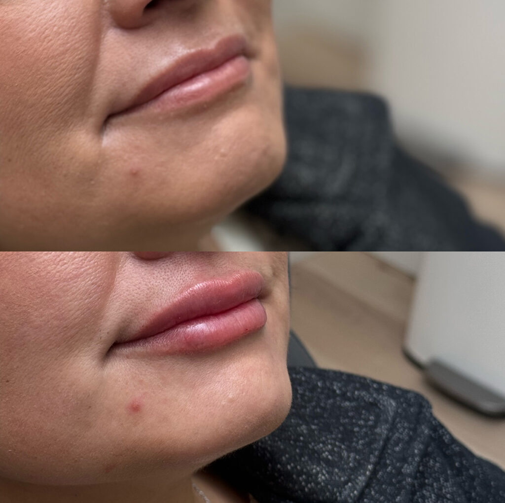 Lip filler before and after photo by The Regenerative & Joint Clinic + Aesthetics in Pocatello, ID